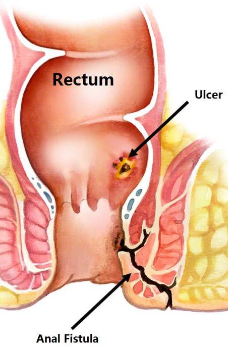 Anal Fistula