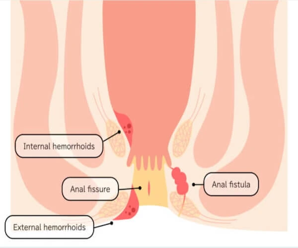 Ayurvedic treatment for anorectal disorders