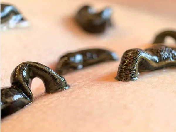 Leech Therapy